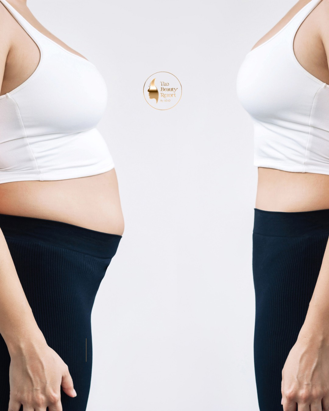 Body contouring result showing a flatter, more toned midsection